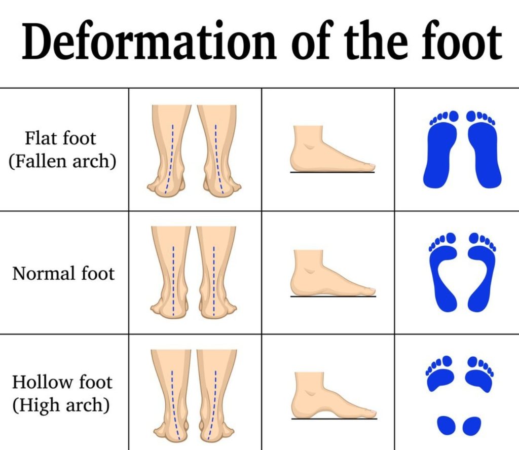Flat Feet imge